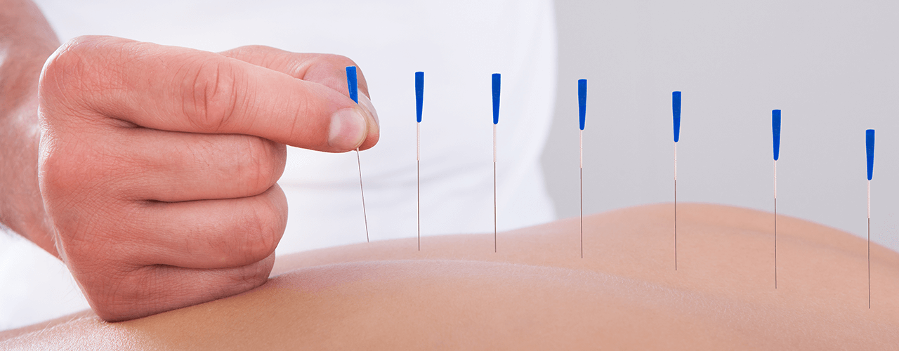 Dry Needling Therapy